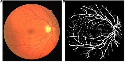 Real-Time Cerebral Vessel Segmentation in Laser <mark class="highlighted">Speckle Contrast</mark> Image Based on Unsupervised Domain Adaptation